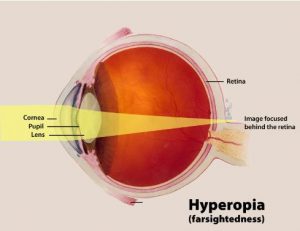 Longsightedness Image